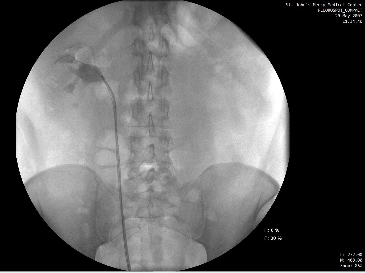 Doctor trying to grab the offending kidney stone in my right kidney.