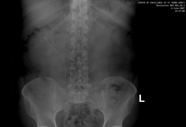 X-Ray of stent from urethra to ureter and up to the right kidney.