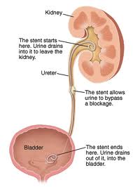 stent diagram